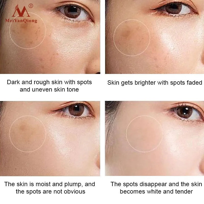 20g Herb Powerful Whitening Freckle Cream Remove Acne Spots Melanin Dark Spots Face Moisturizing Face Skin Care Beauty Yun Nan