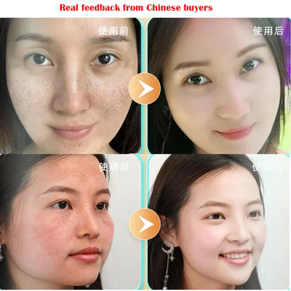 20g Herb Powerful Whitening Freckle Cream Remove Acne Spots Melanin Dark Spots Face Moisturizing Face Skin Care Beauty Yun Nan